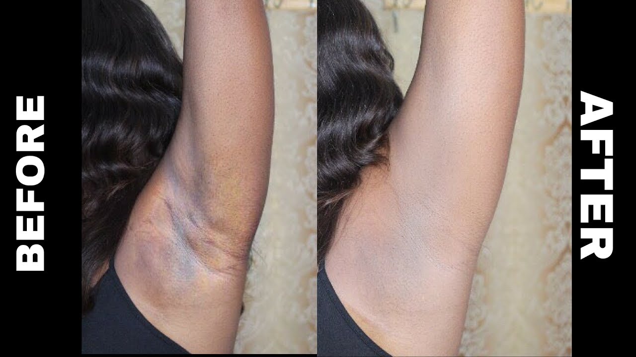 before after underarm whitening cream in uk
