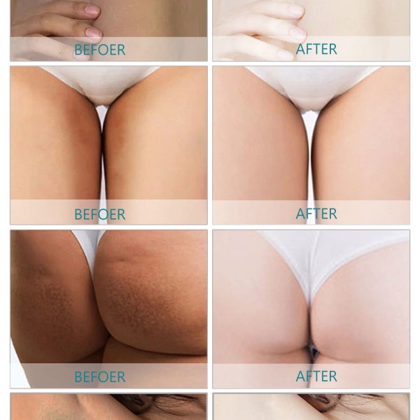 Best Bleaching Cream for Private Areas Intimate Area Whitening Cream