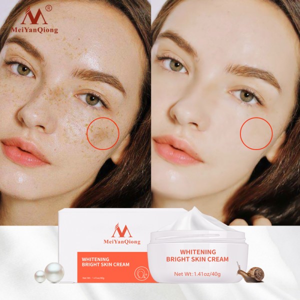 Powerful Whitening Freckle Cream Removes Acne Spots Melanin Dark Spots