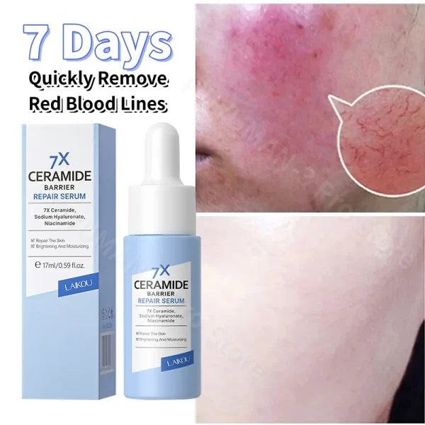 Cream for Rosacea UK
