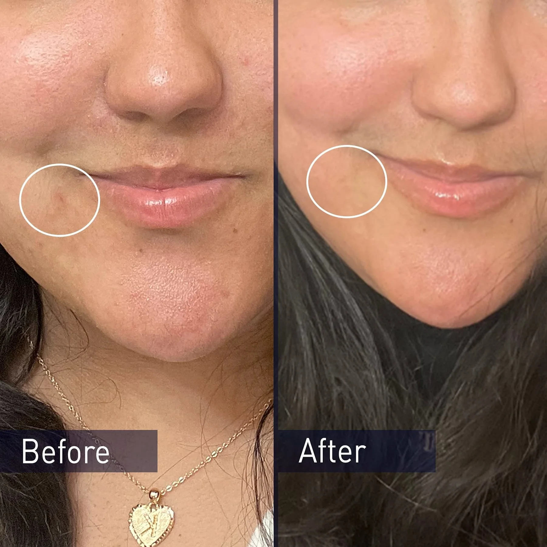 Benzoyl Peroxide Pimple Cream before after 